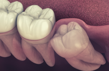 Wisdom Tooth Removal Werribee